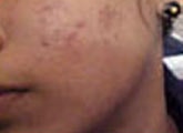 Acne Treatment Results - Before and After Photos
