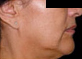 Before Fractional Laser