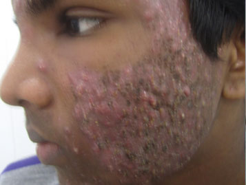 Acne Vulgaris