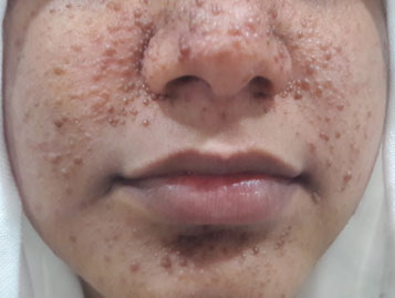 Adenoma sebaceous before surgical