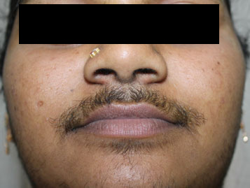 Laser treatment for chin hair clearance removal