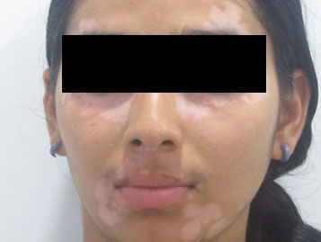 Vitiligo  Types, Causes, and Treatment in Thalassery & Coimbatore
