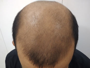 Platelet rich plasma hair growth