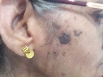 Seborrheic keratosis