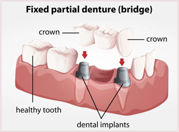 Dental bridges