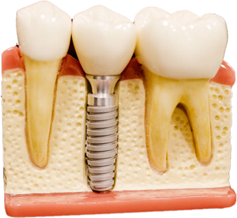 Dental Implants