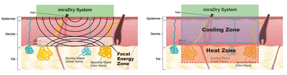 miraDry treatment