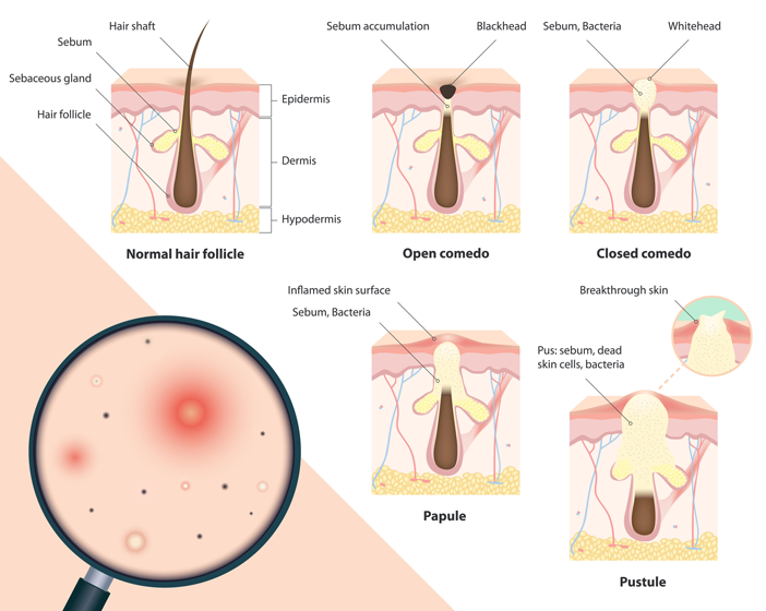 Types of Acne