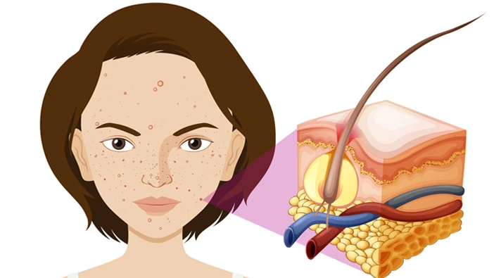 Acne or Pimples of the skin