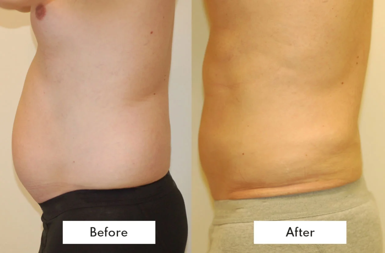 Non surgical fat reduction before after
